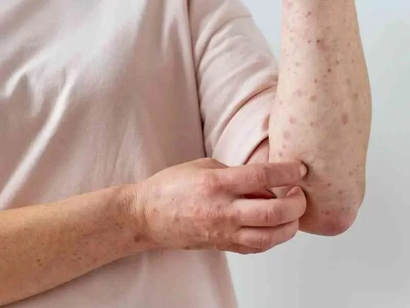 Salud Pública confirma el séptimo caso de viruela del mono en el país